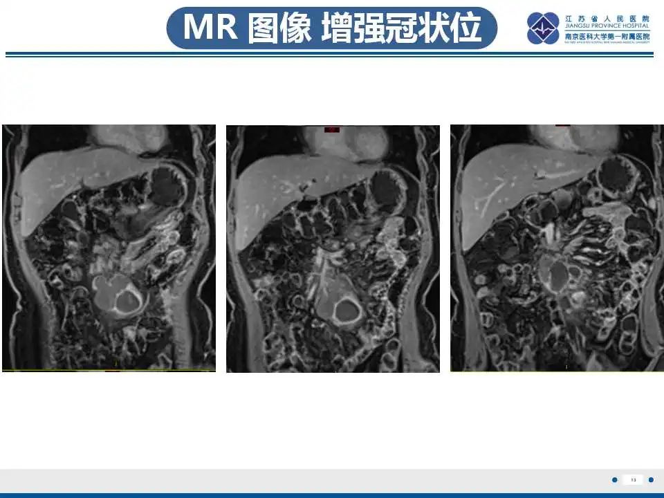 影像PPT - 【PPT】腹腔里的“三明治”—肠系膜淋巴瘤-14