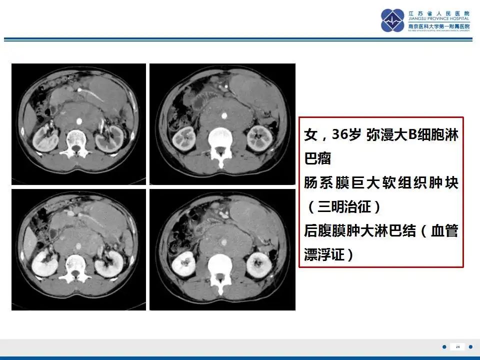 影像PPT - 【PPT】腹腔里的“三明治”—肠系膜淋巴瘤-27