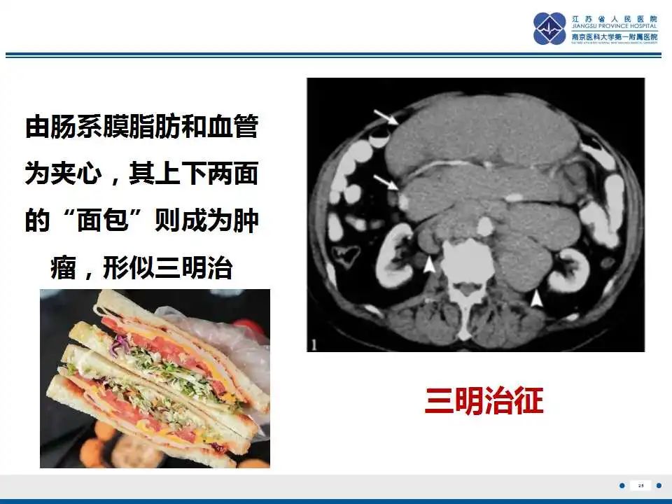 影像PPT - 【PPT】腹腔里的“三明治”—肠系膜淋巴瘤-26