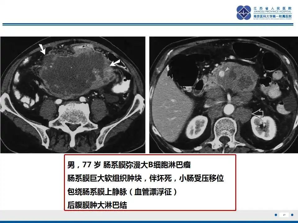 影像PPT - 【PPT】腹腔里的“三明治”—肠系膜淋巴瘤-28