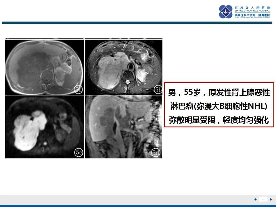 影像PPT - 【PPT】腹腔里的“三明治”—肠系膜淋巴瘤-34