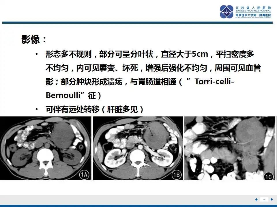 影像PPT - 【PPT】腹腔里的“三明治”—肠系膜淋巴瘤-40