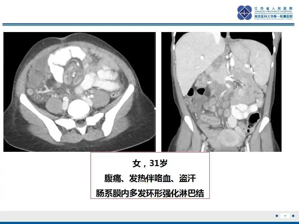 影像PPT - 【PPT】腹腔里的“三明治”—肠系膜淋巴瘤-38
