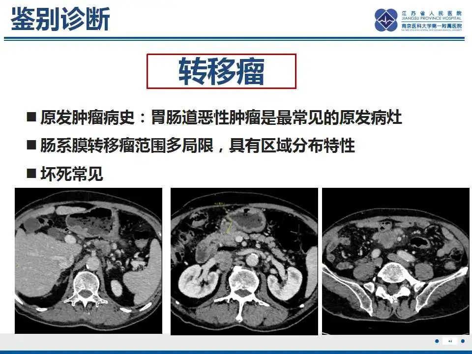 影像PPT - 【PPT】腹腔里的“三明治”—肠系膜淋巴瘤-41