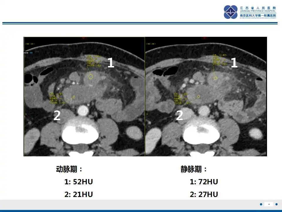 影像PPT - 【PPT】腹腔里的“三明治”—肠系膜淋巴瘤-1