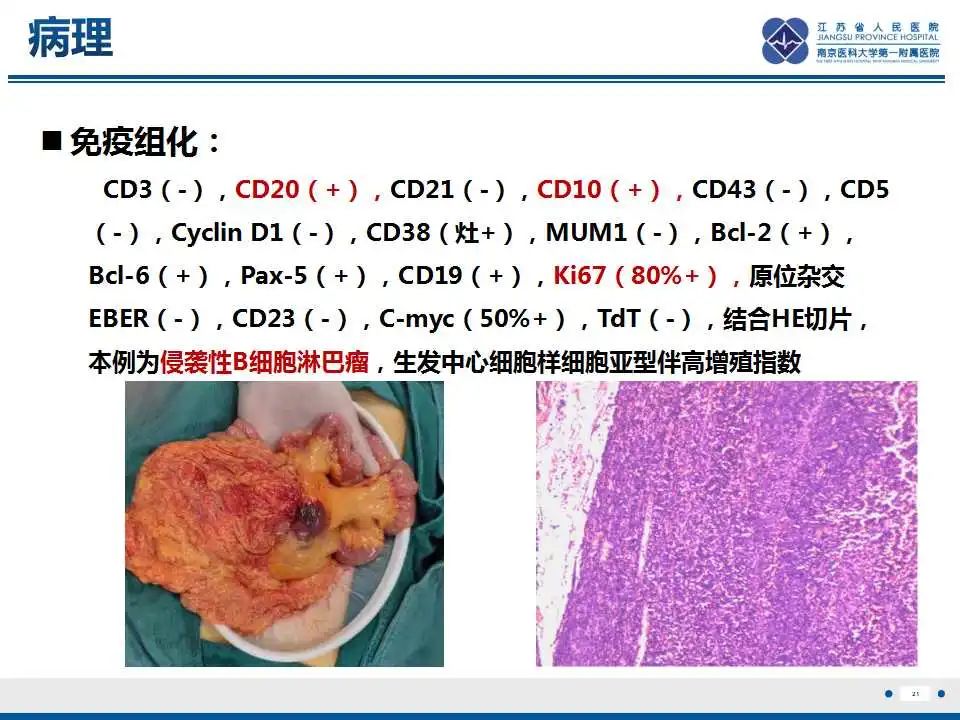 影像PPT - 【PPT】腹腔里的“三明治”—肠系膜淋巴瘤-3