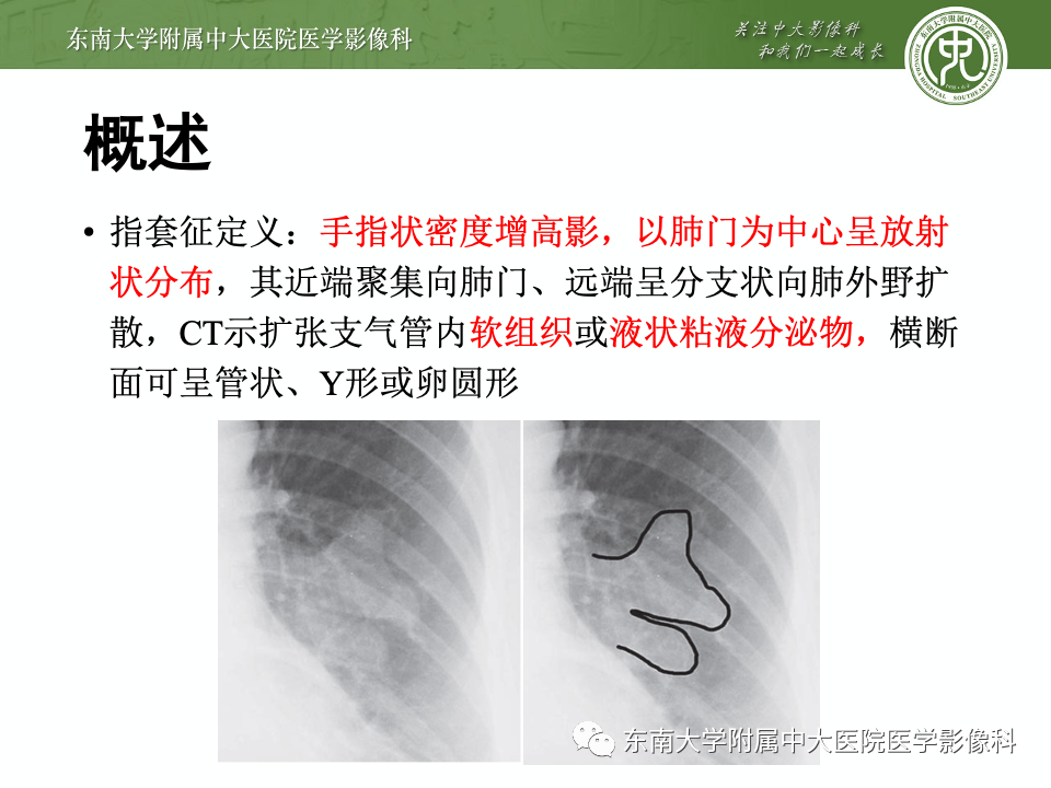 影像PPT - 【PPT】指套征相关病变诊断与鉴别-7 影像PPT - 【PPT】指套征相关病变诊断与鉴别-7