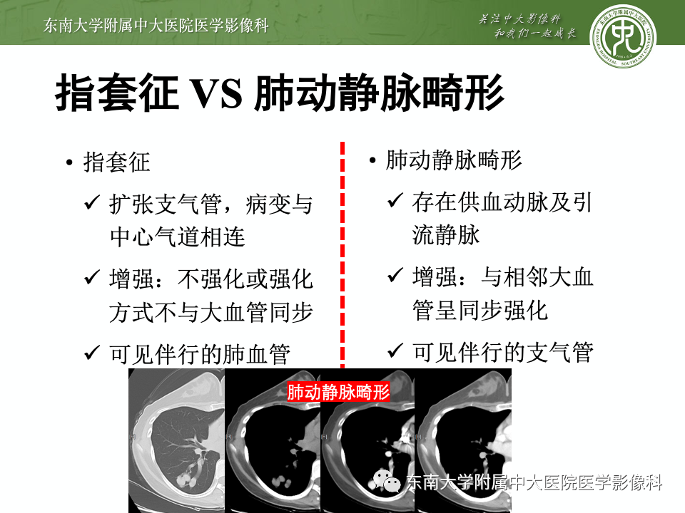 影像PPT - 【PPT】指套征相关病变诊断与鉴别-8 影像PPT - 【PPT】指套征相关病变诊断与鉴别-8