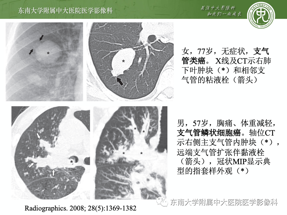 影像PPT - 【PPT】指套征相关病变诊断与鉴别-12 影像PPT - 【PPT】指套征相关病变诊断与鉴别-12
