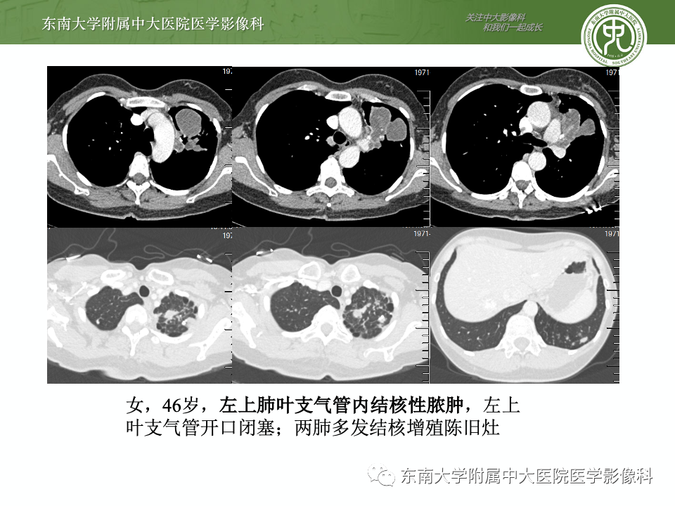 影像PPT - 【PPT】指套征相关病变诊断与鉴别-19 影像PPT - 【PPT】指套征相关病变诊断与鉴别-19