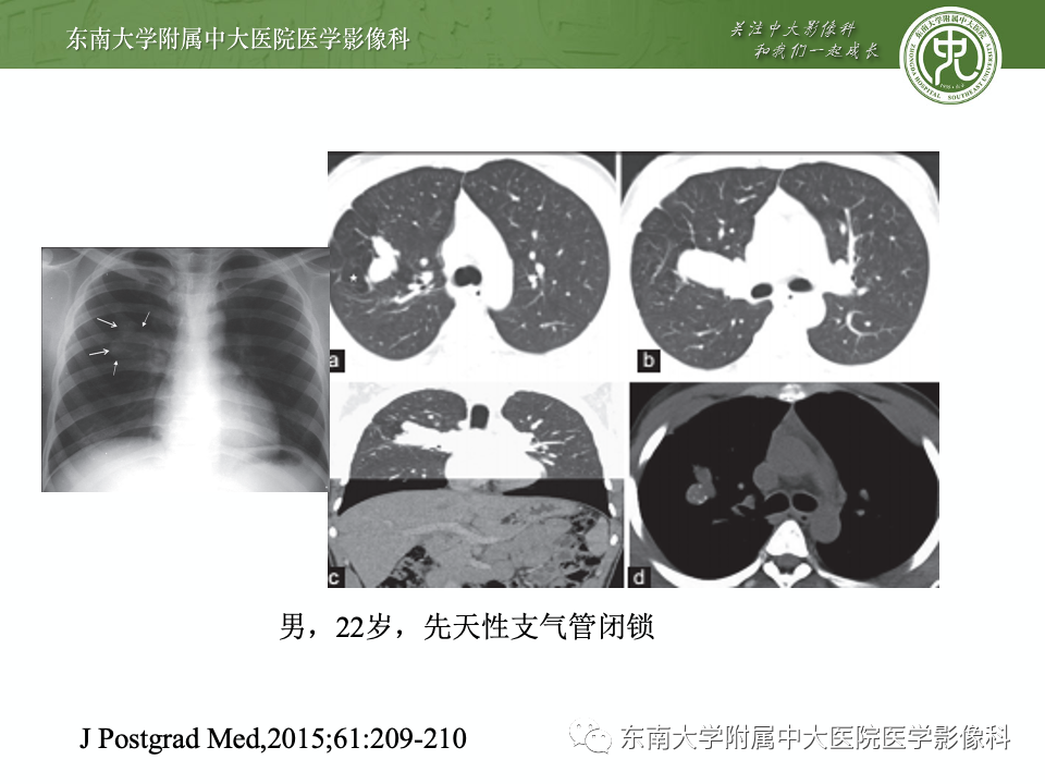 影像PPT - 【PPT】指套征相关病变诊断与鉴别-21 影像PPT - 【PPT】指套征相关病变诊断与鉴别-21