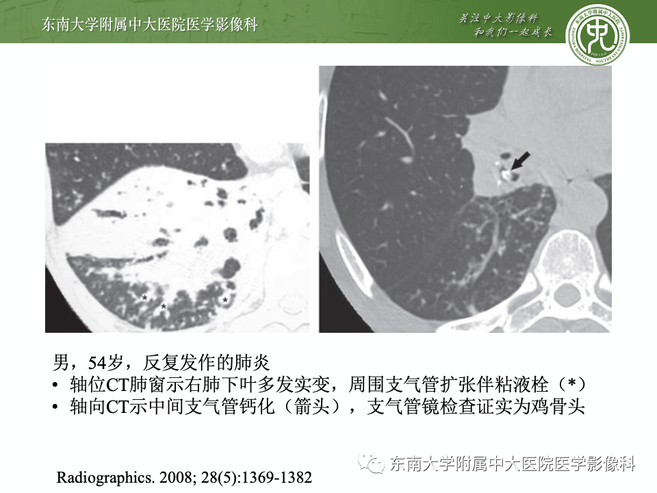 影像PPT - 【PPT】指套征相关病变诊断与鉴别-25 影像PPT - 【PPT】指套征相关病变诊断与鉴别-25