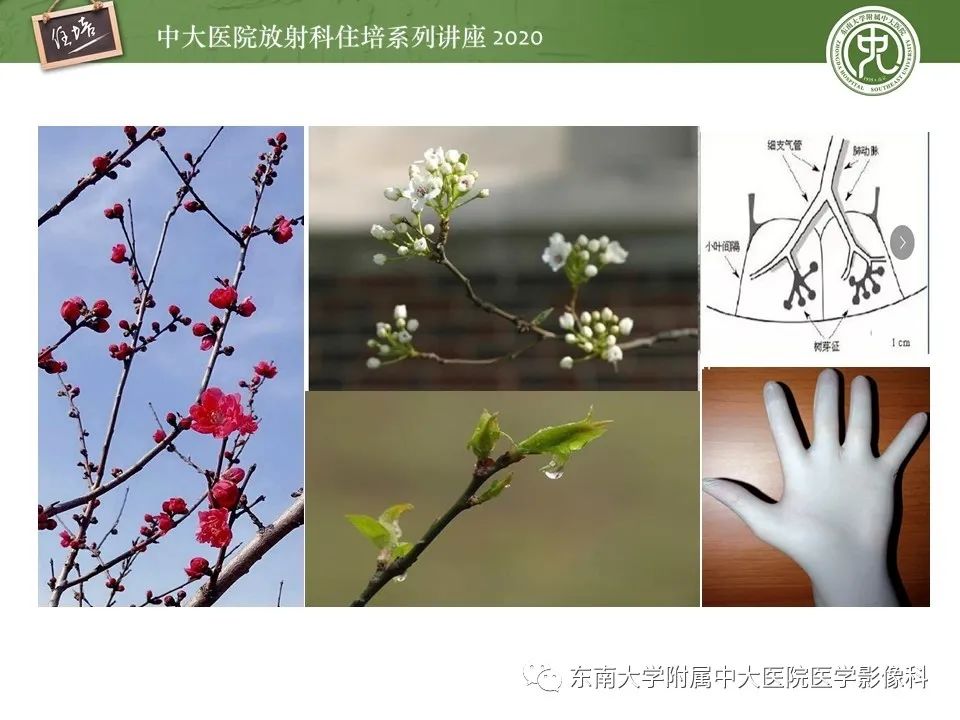 影像PPT - 【PPT】肺内常见影像征象解读 （树芽征、指套征）-2