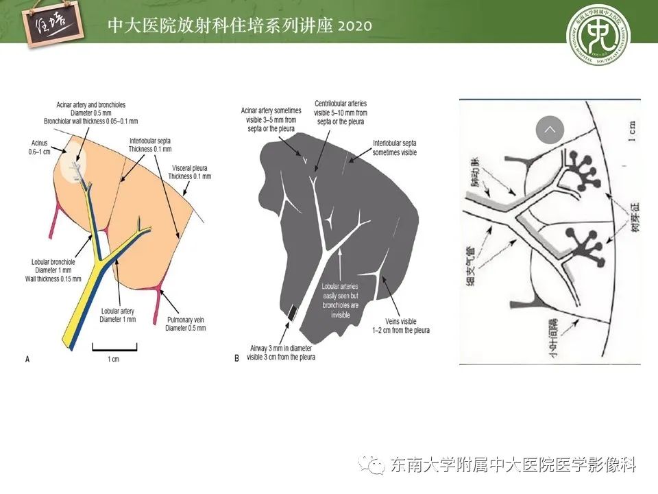 影像PPT - 【PPT】肺内常见影像征象解读 （树芽征、指套征）-6