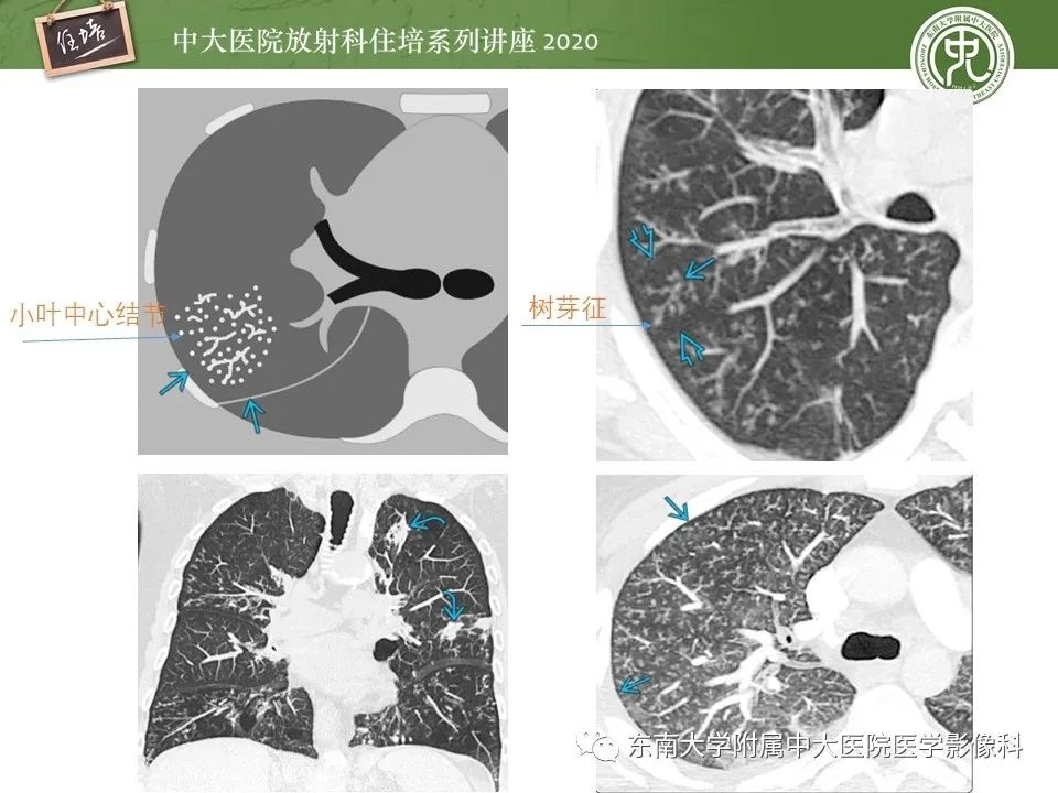 影像PPT - 【PPT】肺内常见影像征象解读 （树芽征、指套征）-8