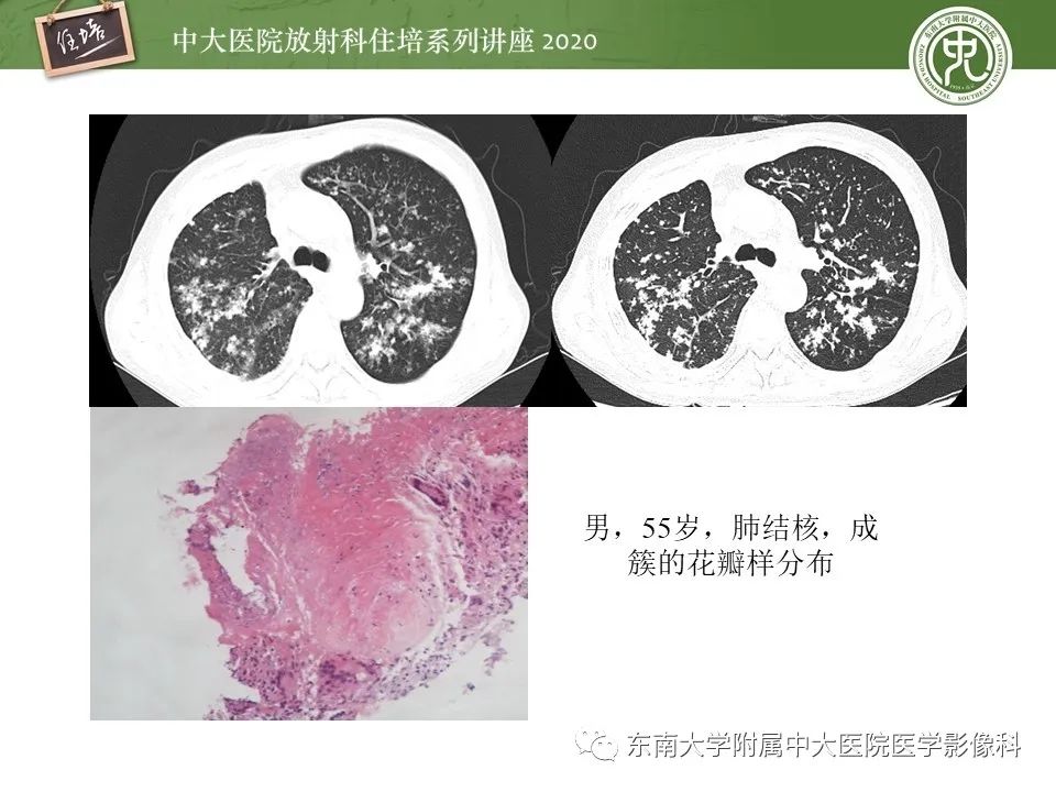 影像PPT - 【PPT】肺内常见影像征象解读 （树芽征、指套征）-12