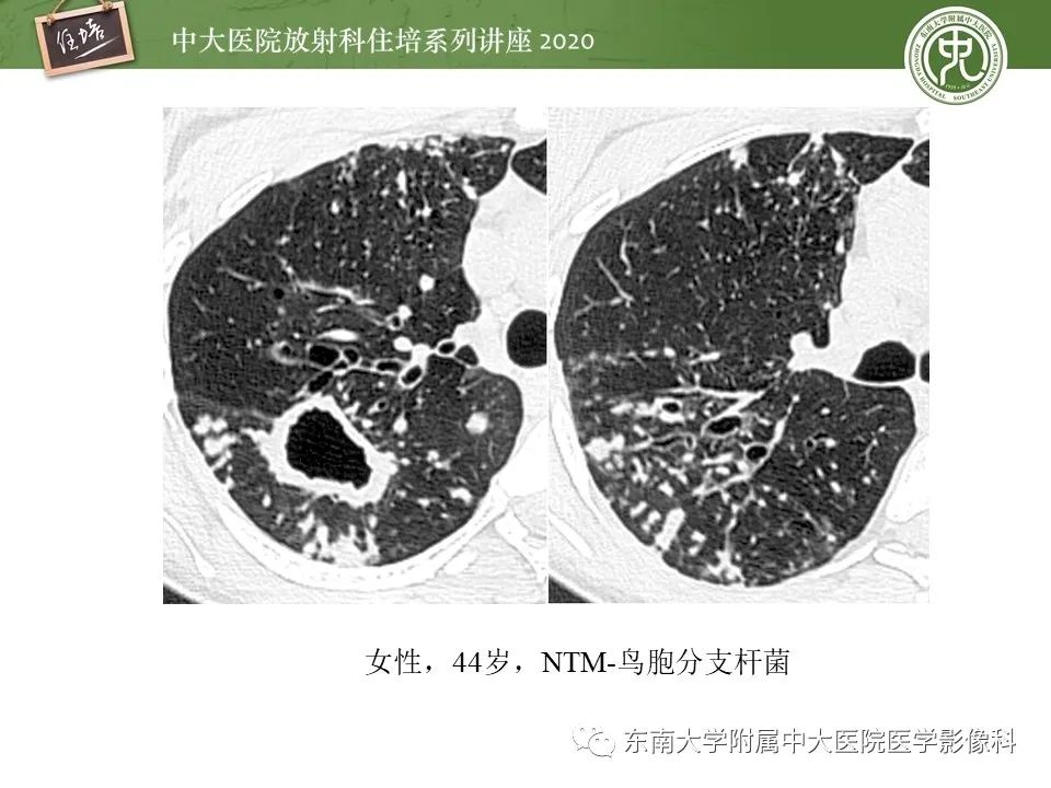 影像PPT - 【PPT】肺内常见影像征象解读 （树芽征、指套征）-13