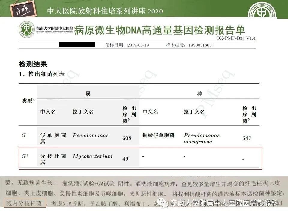 影像PPT - 【PPT】肺内常见影像征象解读 （树芽征、指套征）-15