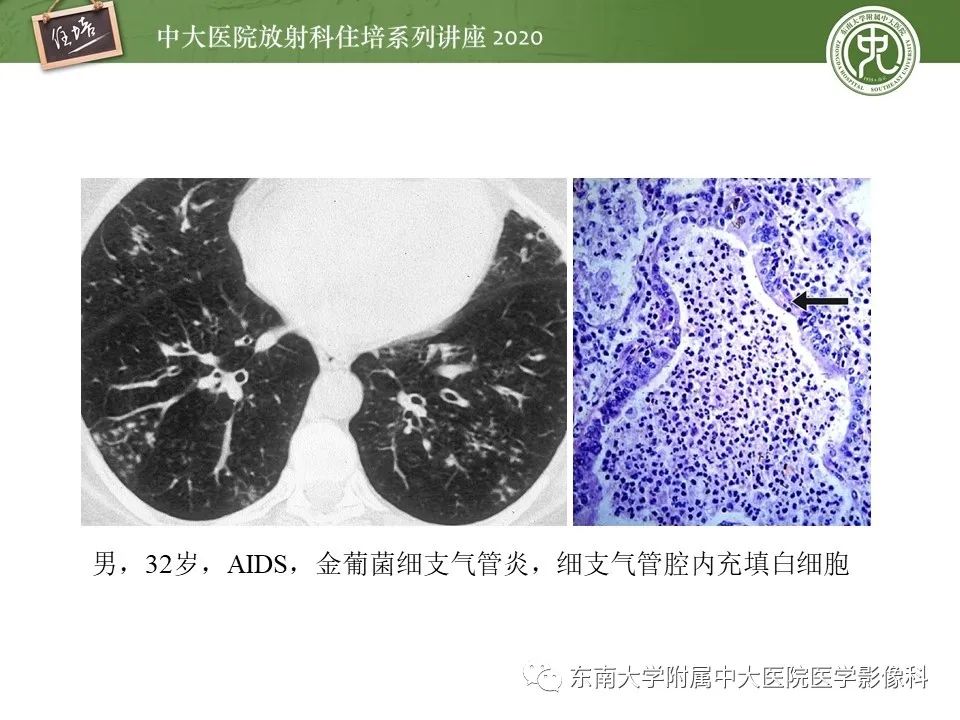 影像PPT - 【PPT】肺内常见影像征象解读 （树芽征、指套征）-16