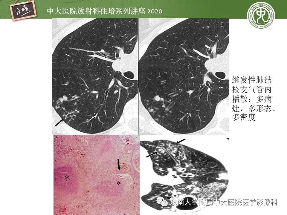 影像PPT - 【PPT】肺内常见影像征象解读 （树芽征、指套征）-11