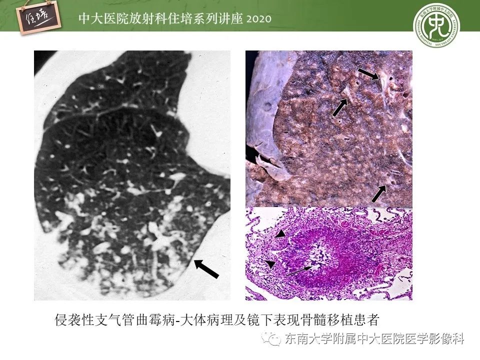影像PPT - 【PPT】肺内常见影像征象解读 （树芽征、指套征）-17