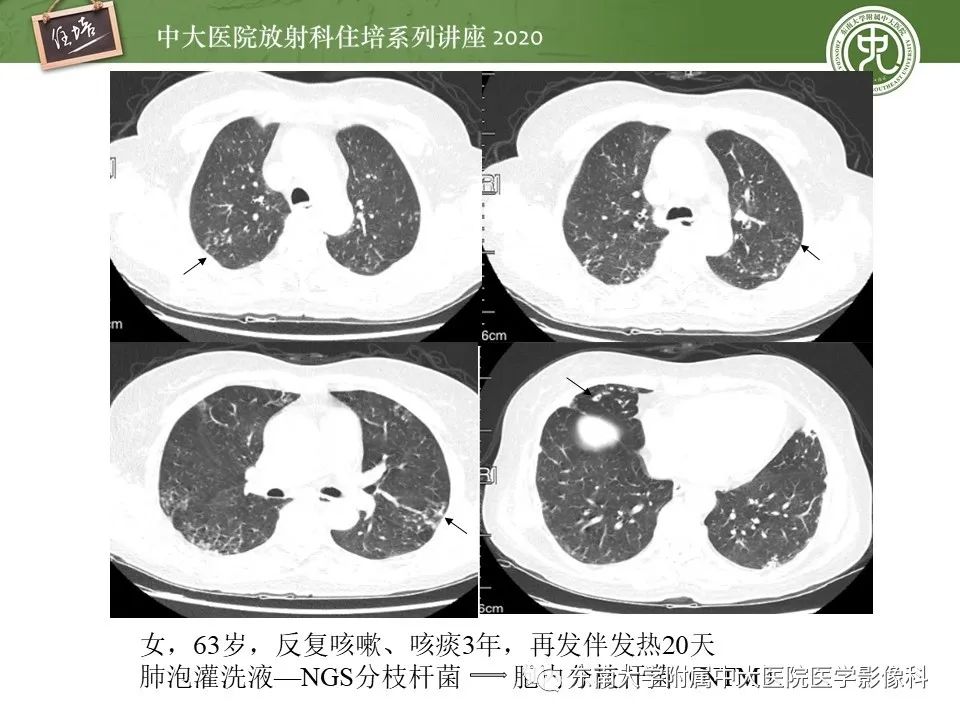 影像PPT - 【PPT】肺内常见影像征象解读 （树芽征、指套征）-14