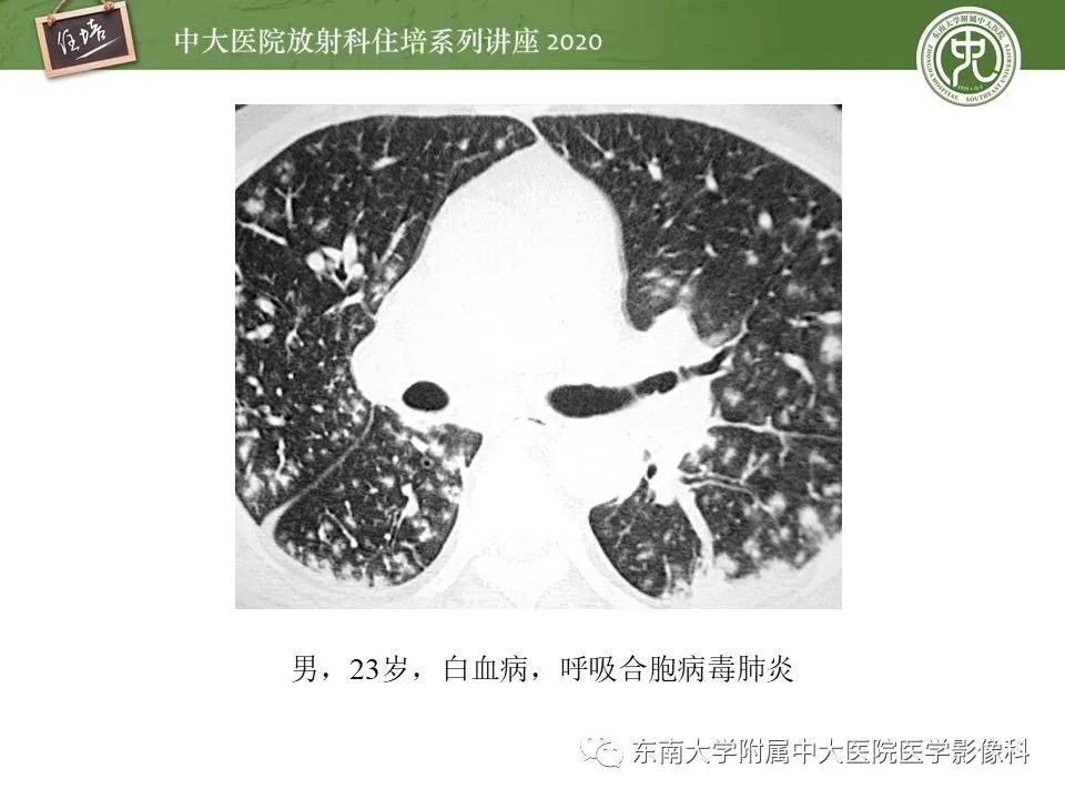 影像PPT - 【PPT】肺内常见影像征象解读 （树芽征、指套征）-20