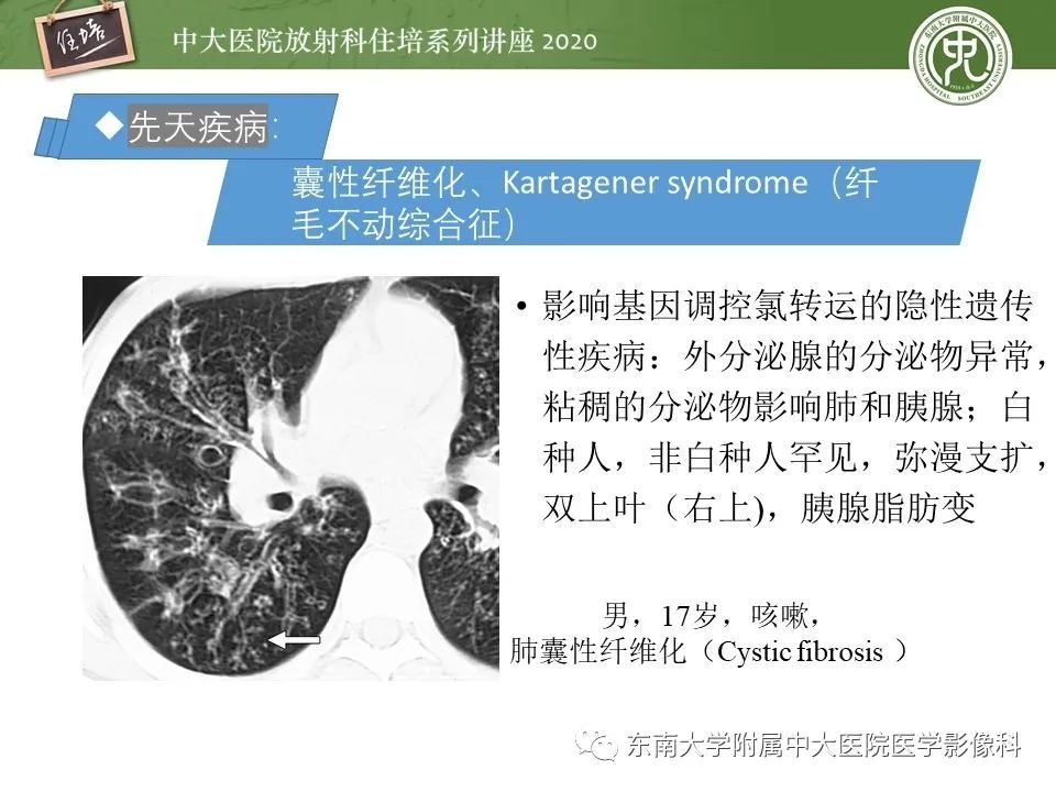 影像PPT - 【PPT】肺内常见影像征象解读 （树芽征、指套征）-21
