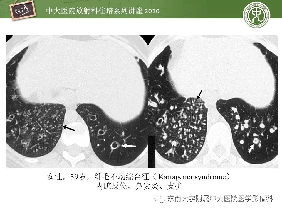 影像PPT - 【PPT】肺内常见影像征象解读 （树芽征、指套征）-22