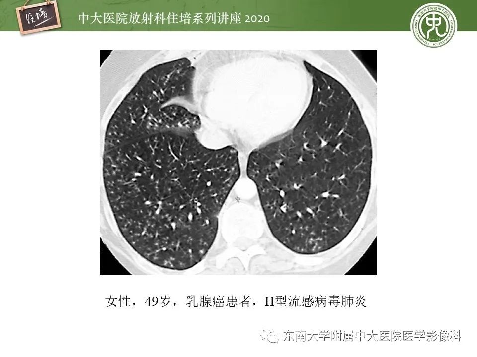 影像PPT - 【PPT】肺内常见影像征象解读 （树芽征、指套征）-18