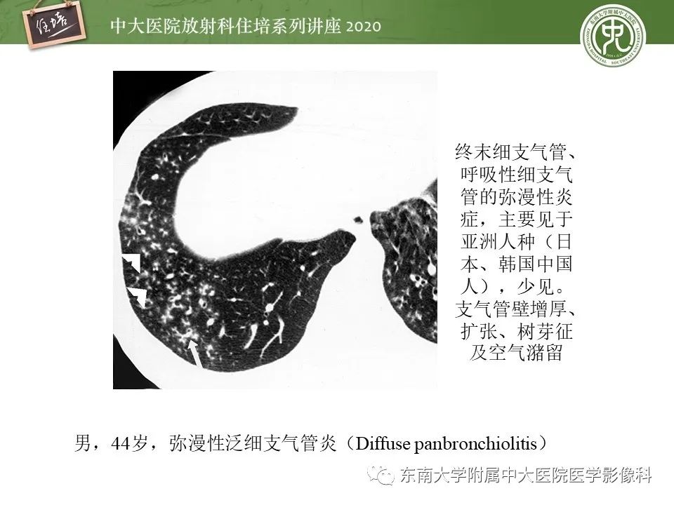 影像PPT - 【PPT】肺内常见影像征象解读 （树芽征、指套征）-24