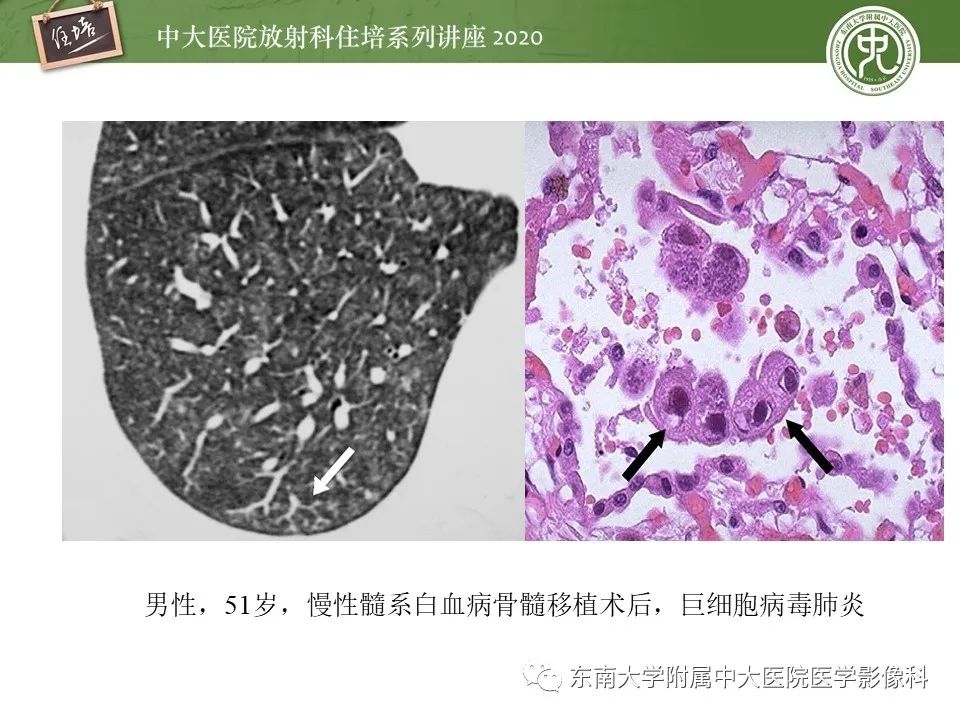 影像PPT - 【PPT】肺内常见影像征象解读 （树芽征、指套征）-19