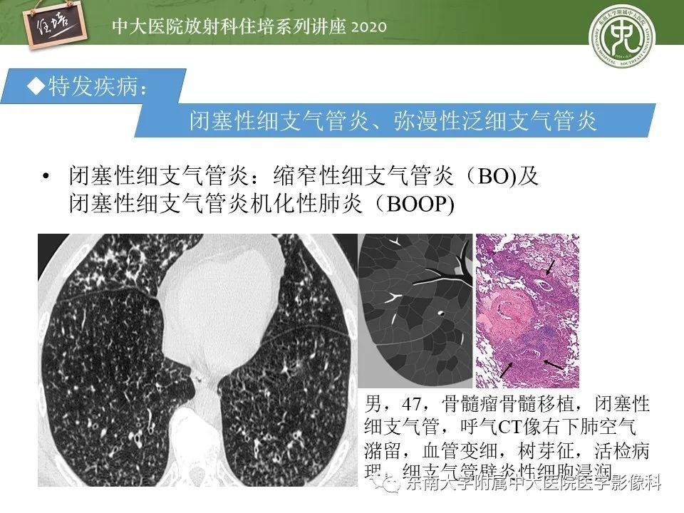 影像PPT - 【PPT】肺内常见影像征象解读 （树芽征、指套征）-23