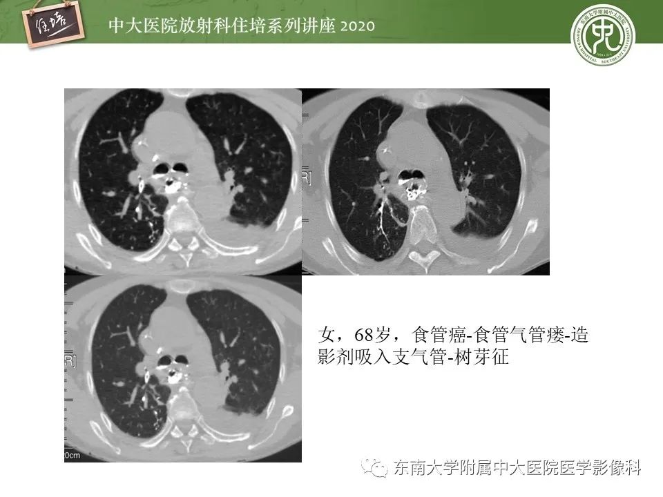 影像PPT - 【PPT】肺内常见影像征象解读 （树芽征、指套征）-27