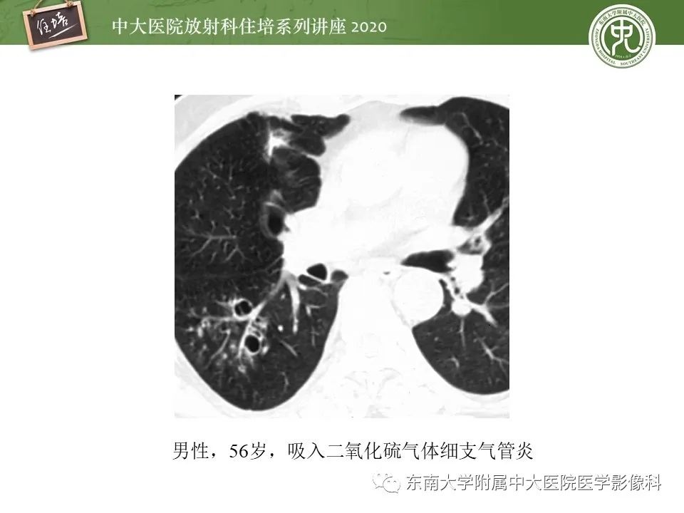 影像PPT - 【PPT】肺内常见影像征象解读 （树芽征、指套征）-28