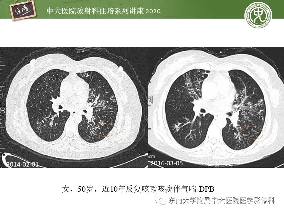 影像PPT - 【PPT】肺内常见影像征象解读 （树芽征、指套征）-25