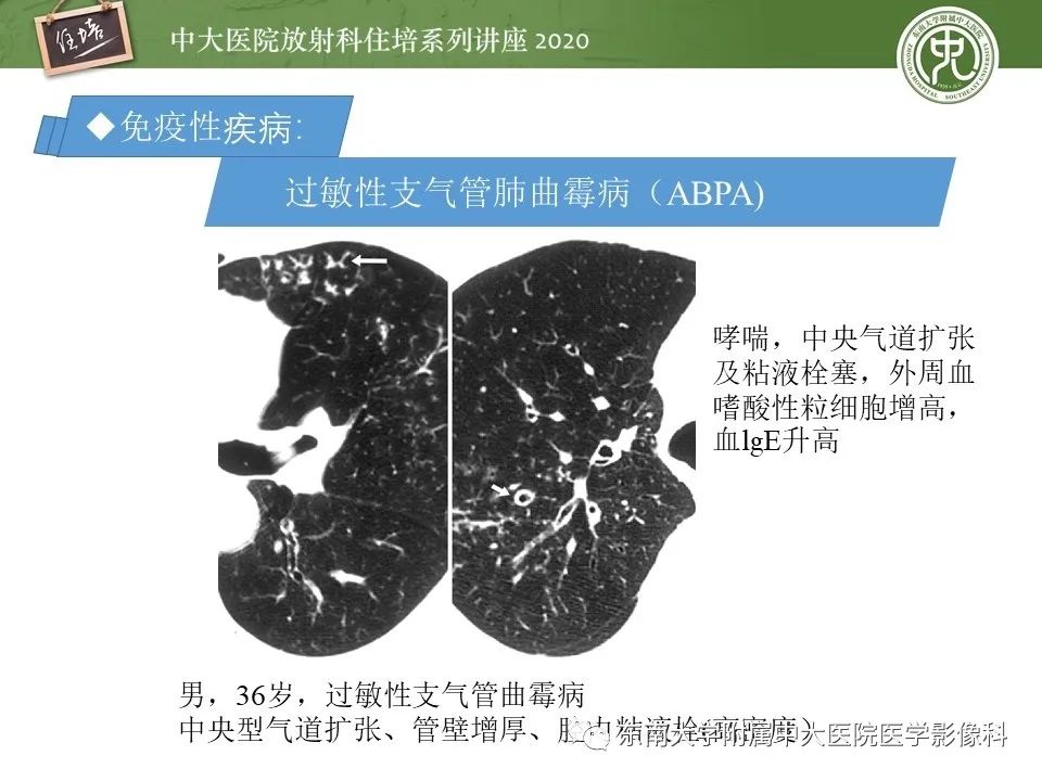 影像PPT - 【PPT】肺内常见影像征象解读 （树芽征、指套征）-29