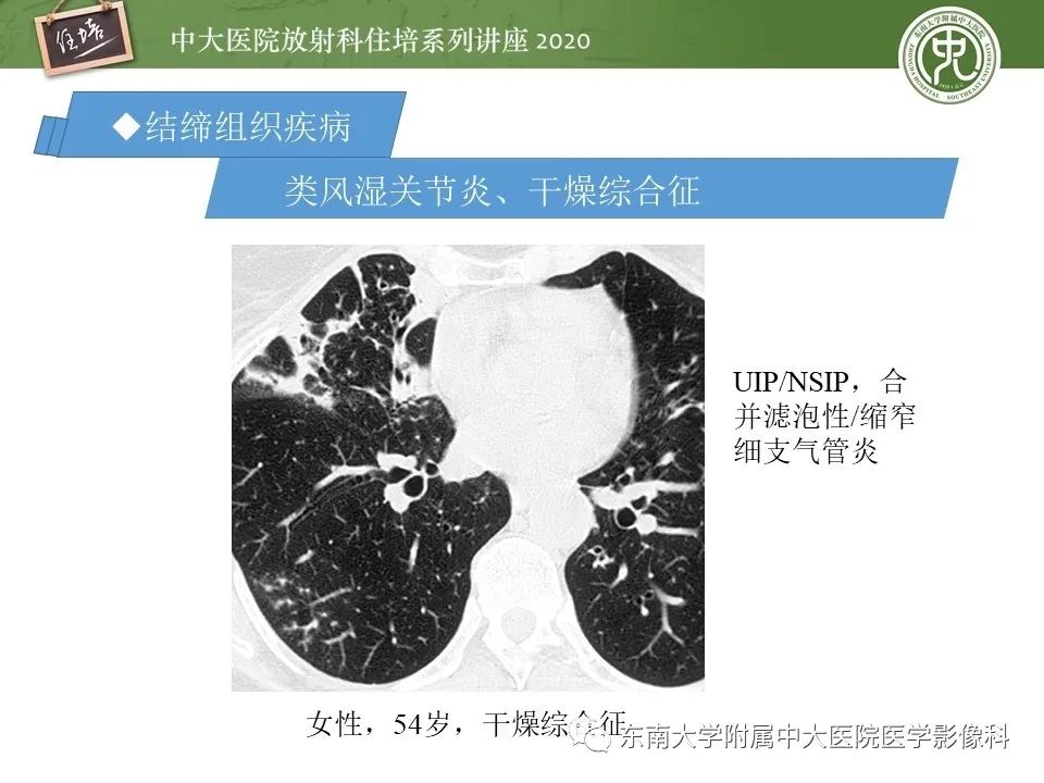 影像PPT - 【PPT】肺内常见影像征象解读 （树芽征、指套征）-30