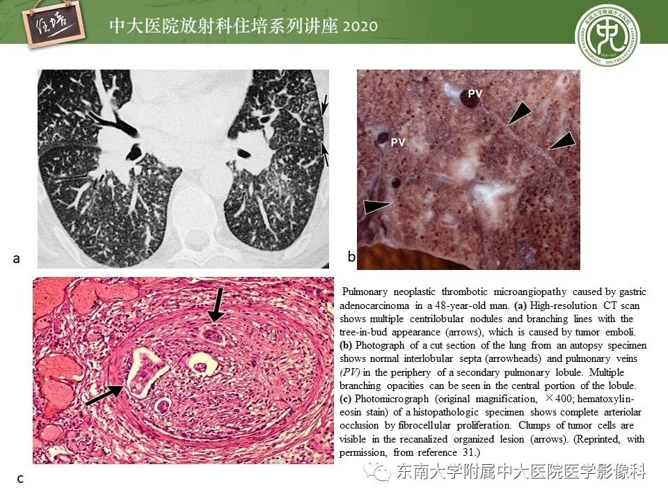 影像PPT - 【PPT】肺内常见影像征象解读 （树芽征、指套征）-32