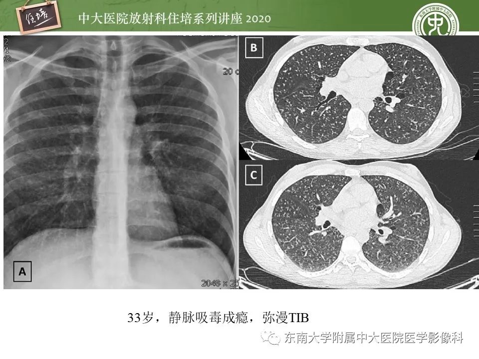 影像PPT - 【PPT】肺内常见影像征象解读 （树芽征、指套征）-33