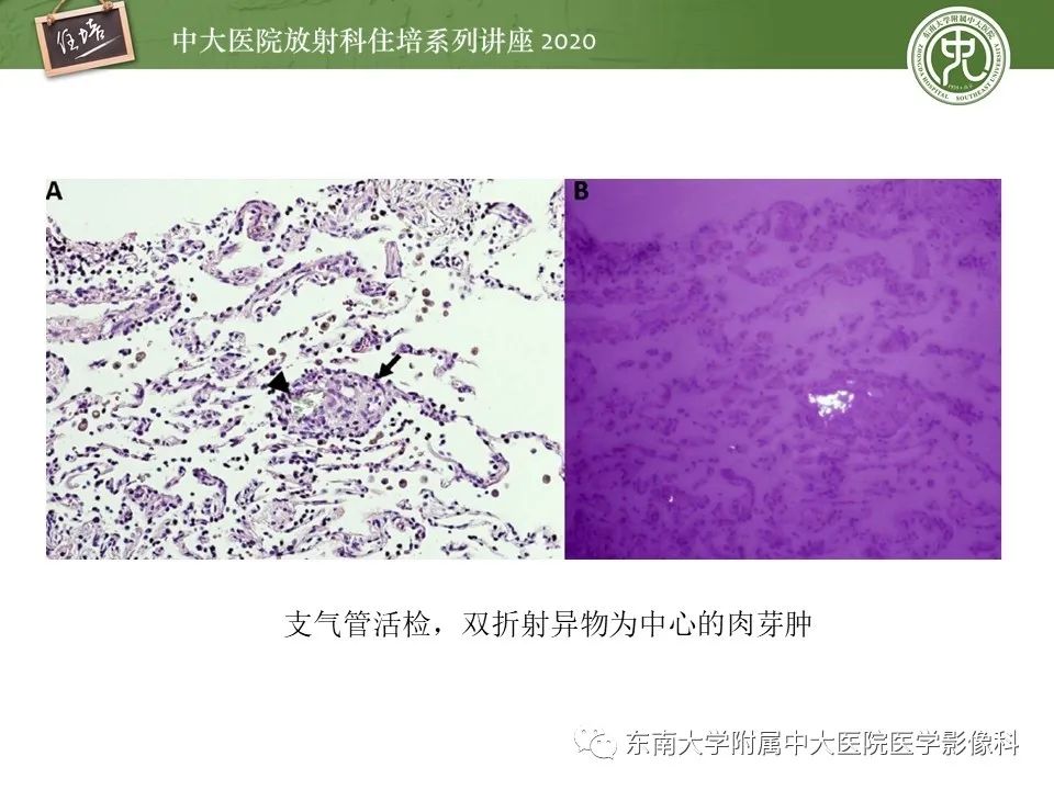 影像PPT - 【PPT】肺内常见影像征象解读 （树芽征、指套征）-34