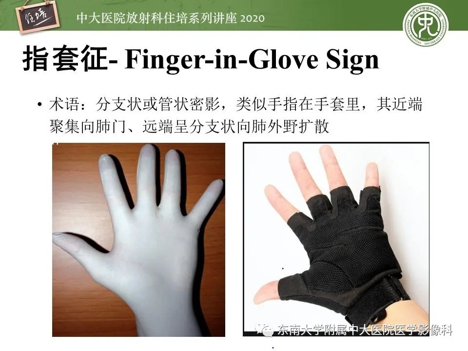 影像PPT - 【PPT】肺内常见影像征象解读 （树芽征、指套征）-36
