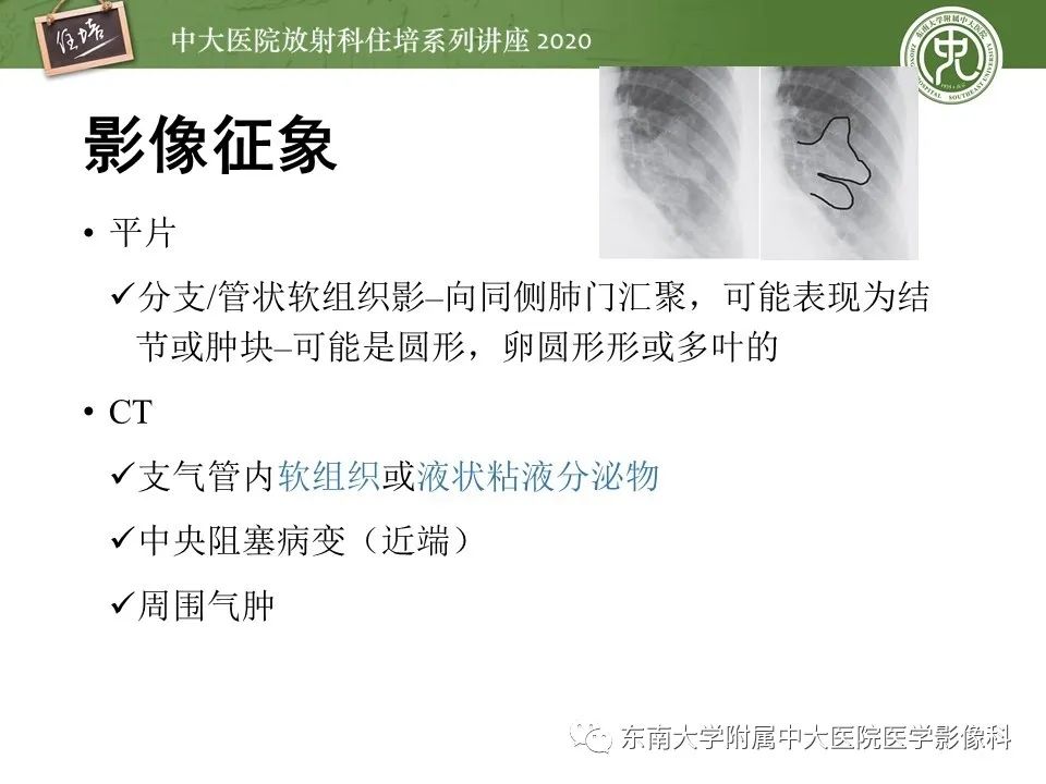影像PPT - 【PPT】肺内常见影像征象解读 （树芽征、指套征）-37