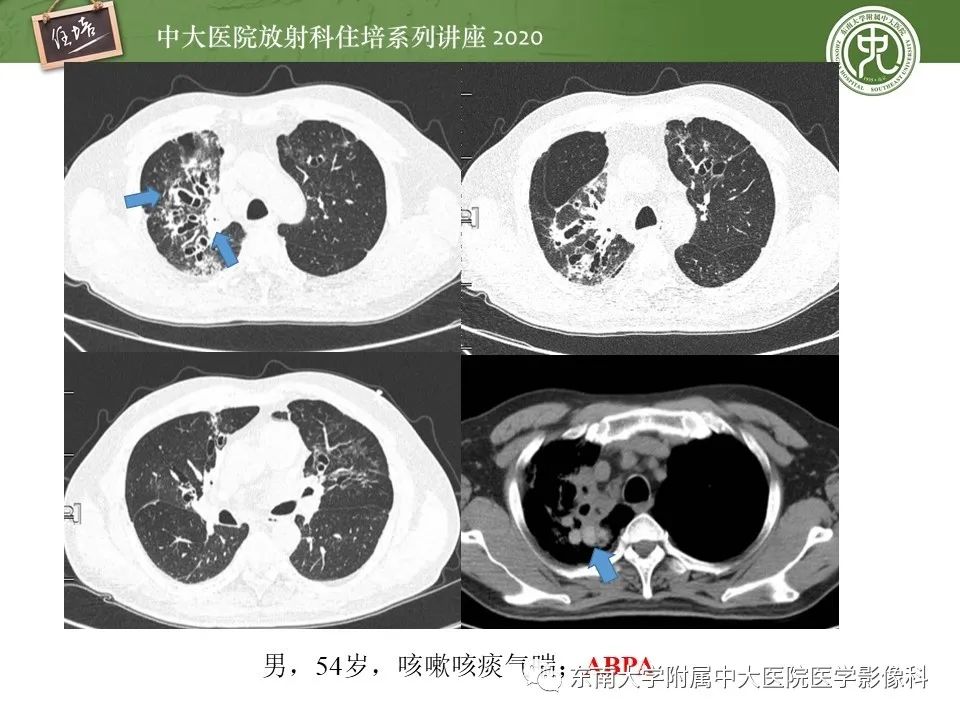 影像PPT - 【PPT】肺内常见影像征象解读 （树芽征、指套征）-40