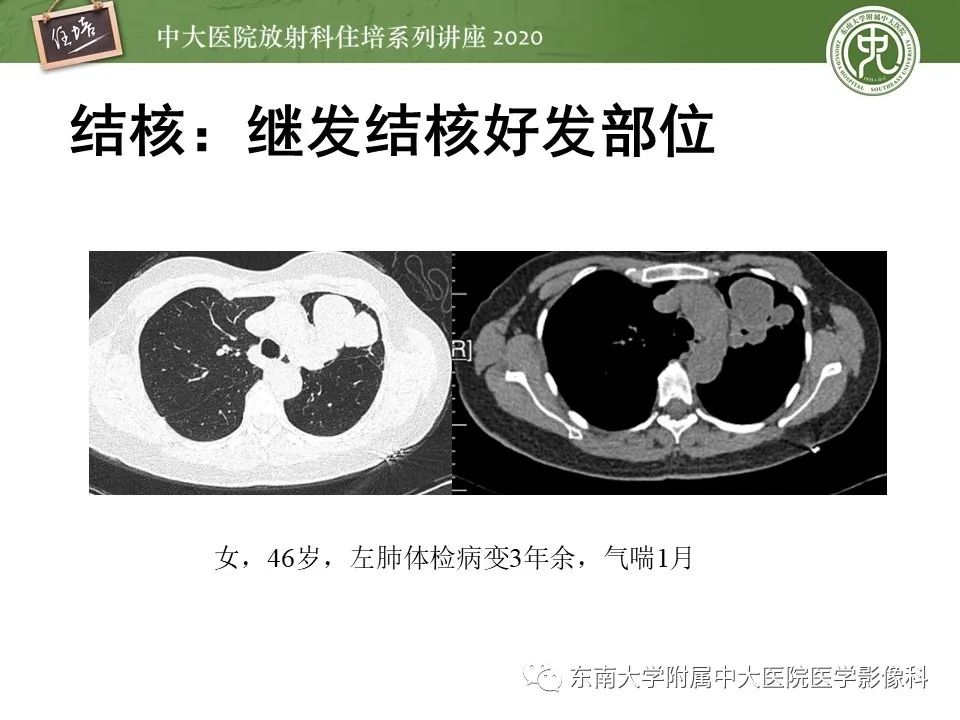 影像PPT - 【PPT】肺内常见影像征象解读 （树芽征、指套征）-41
