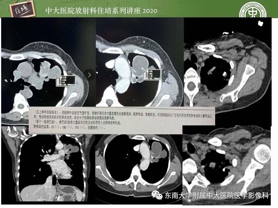 影像PPT - 【PPT】肺内常见影像征象解读 （树芽征、指套征）-42