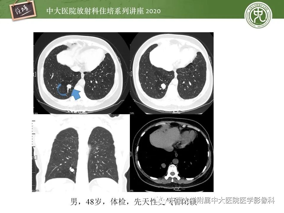 影像PPT - 【PPT】肺内常见影像征象解读 （树芽征、指套征）-44