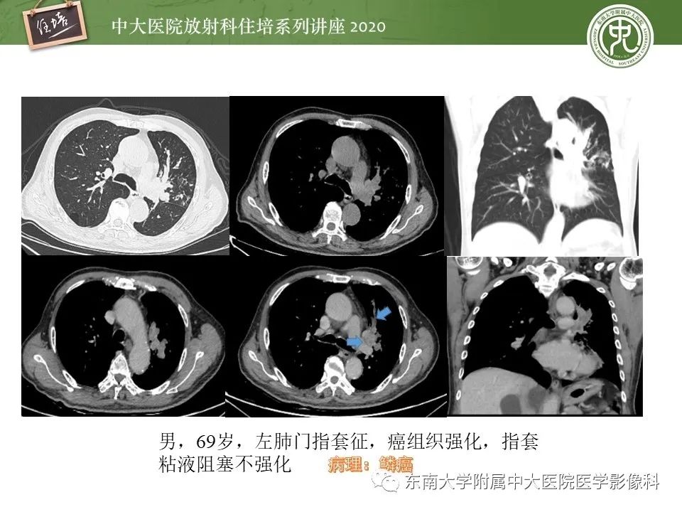 影像PPT - 【PPT】肺内常见影像征象解读 （树芽征、指套征）-46