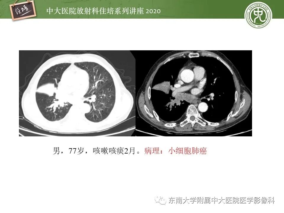 影像PPT - 【PPT】肺内常见影像征象解读 （树芽征、指套征）-47
