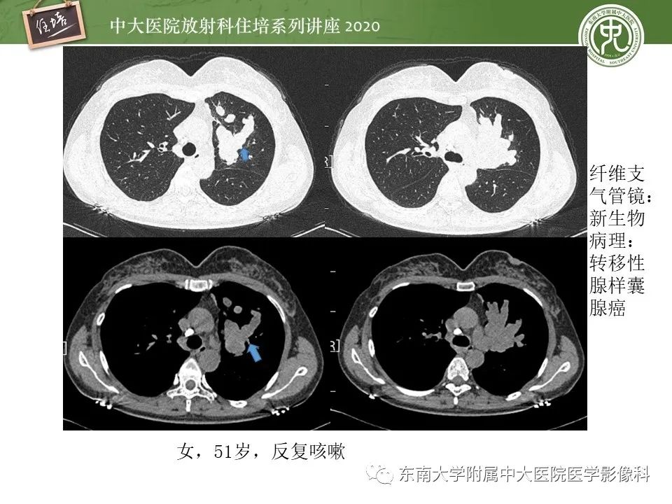 影像PPT - 【PPT】肺内常见影像征象解读 （树芽征、指套征）-48